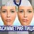 АСИММЕТРИЯ ЛИЦА КАК ИЗБАВИТЬСЯ Запишитесь со скидкой биомеханотерапия симметрия