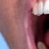 Ice Cream Breaks Tooth