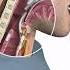 Endotracheal Intubation Education Shorts