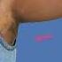 Axillary Breast Tissue Removal Surgery Personiks Hyderabad Dr Gurukarna Vemula