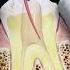 Root Canal Treatment