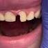 Tiktok Video Dentist Fyp Viral Foryou Love Broken Teeth Blogger Dental Crown