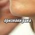 Первые тревожные признаки рака гортани здоровье онкология симптомырака