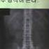 이상훈교수 강직성 척추염의 진단과 치료 운동법